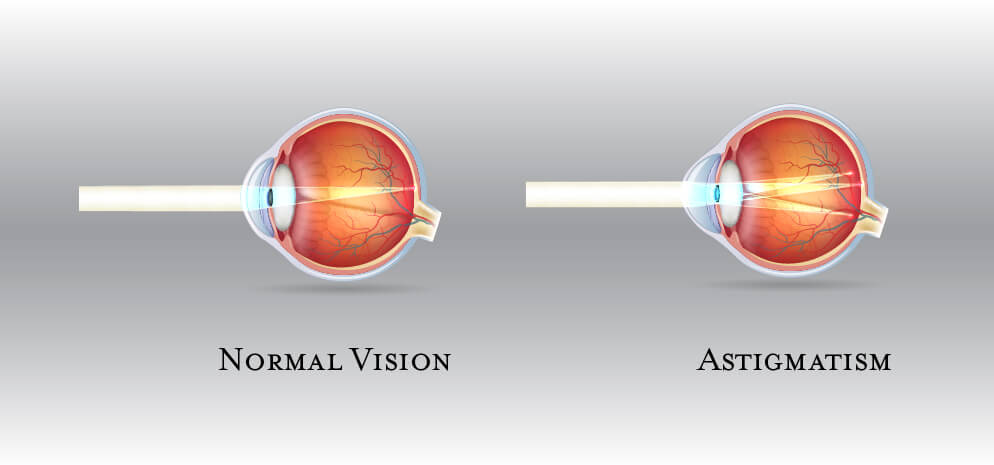 double vision astigmatism