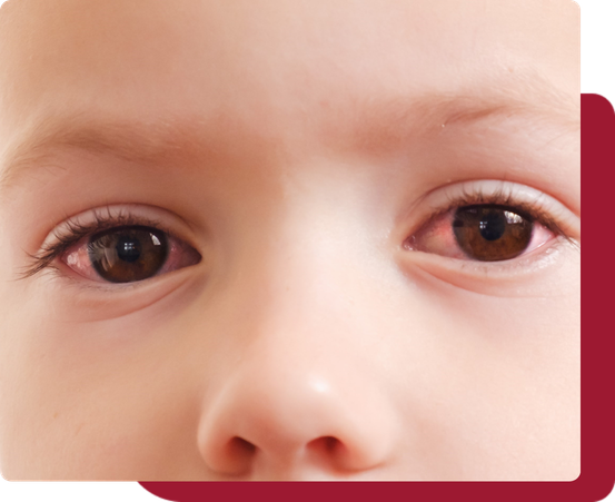 pink eye
